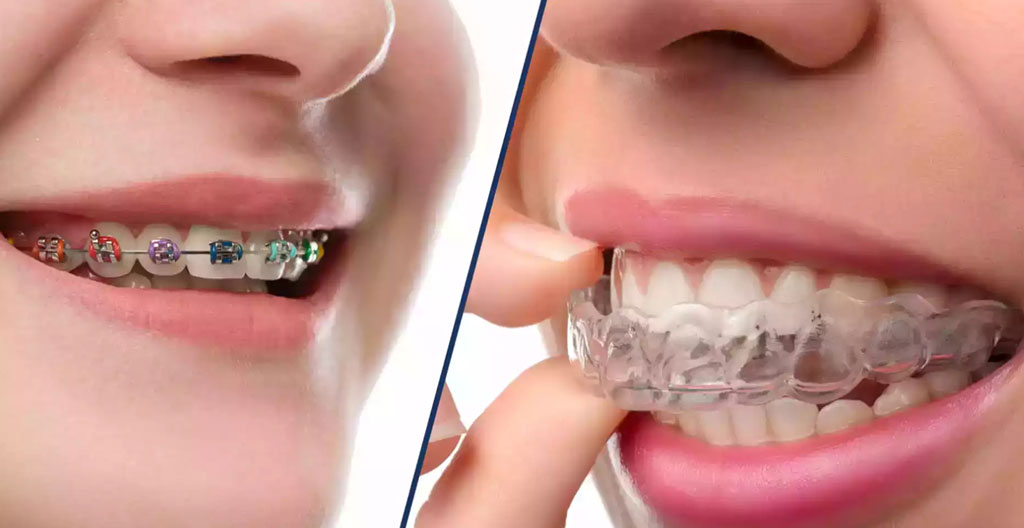 Gros plan sur différents types d'appareils orthodontiques (bagues métalliques, céramiques et gouttières transparentes) tenus par un orthodontiste sur surface clinique blanche